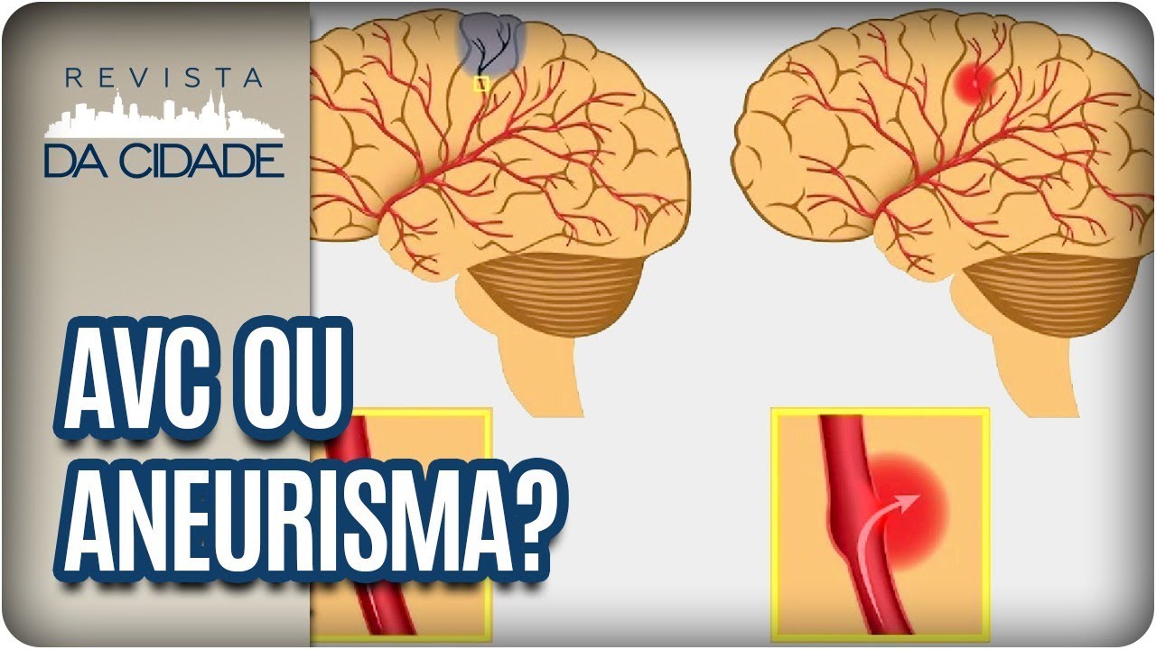 O Que é um Aneurisma e um AVC?