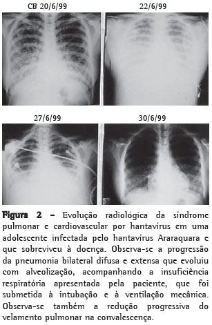 Como Diagnosticar a Bronquiolite e a Pneumonia?