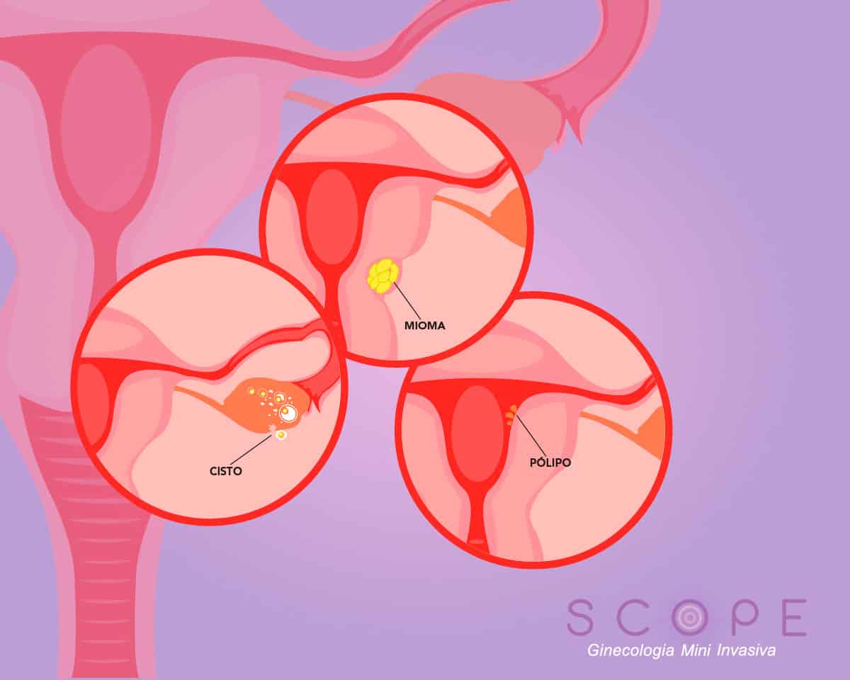 O Que São Cistos e Miomas?