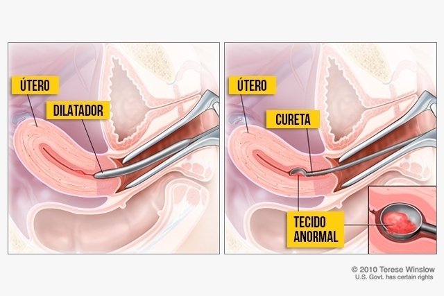 Entendendo os efeitos da curetagem na menstruação