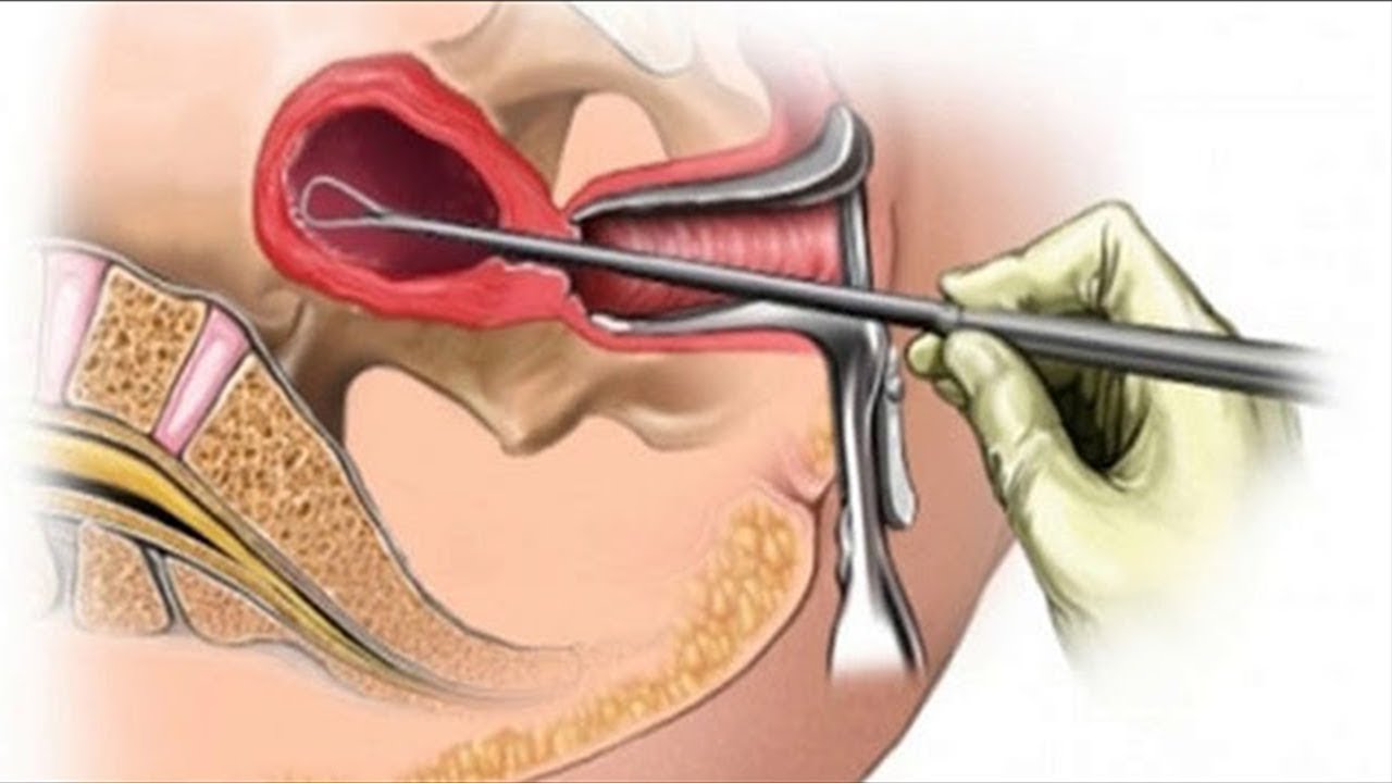 Como Identificar se a Curetagem foi Bem Sucedida?