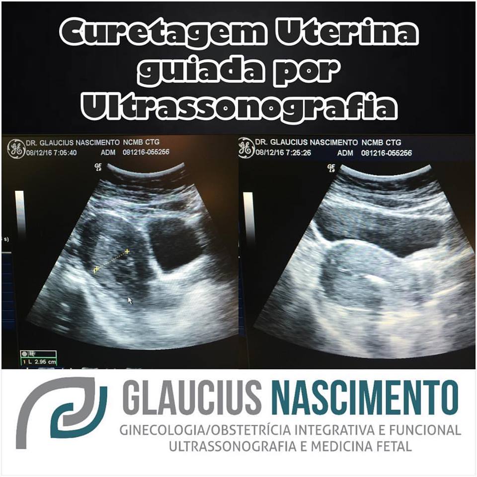 Exames de Imagem para Verificar o Resultado da Curetagem