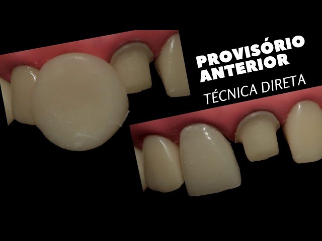 Soluções Caseiras para Se Livrar da Resina nos Dentes