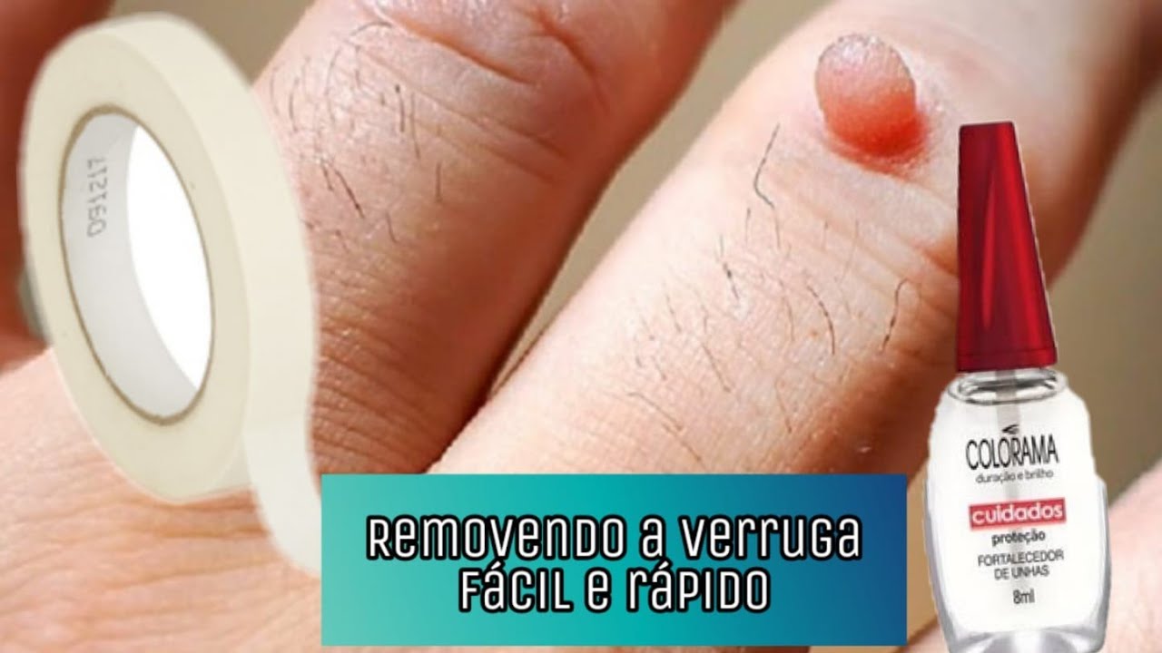 Remova Verrugas com Esmalte de Unha: Descubra Como!