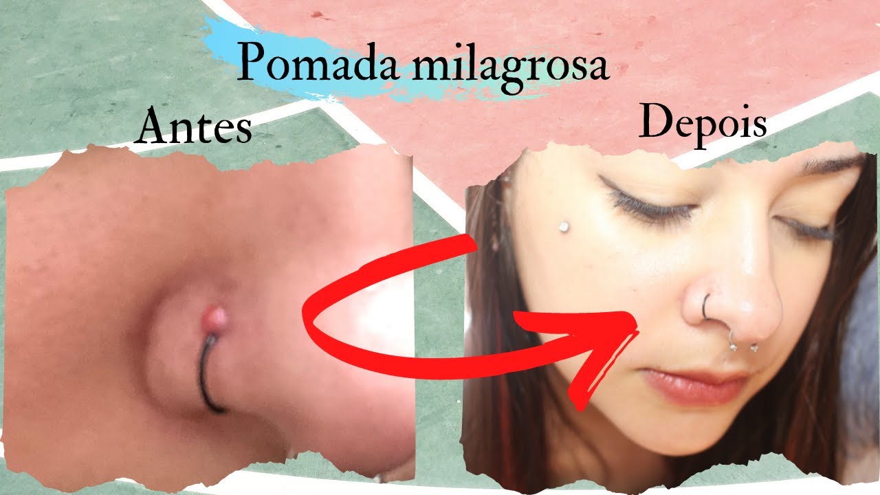 O Que é um Granuloma?