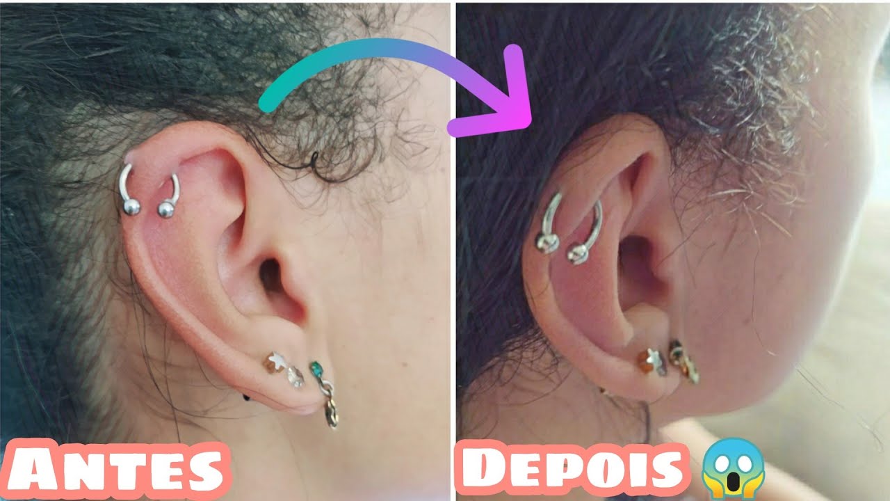 Por que os Piercings podem Desenvolver Granulomas?