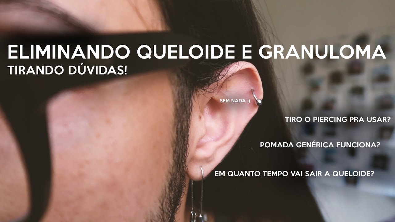 Como Tratar um Granuloma no Piercing?