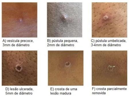 Saiba como prevenir a ocorrência de espinhas no saco