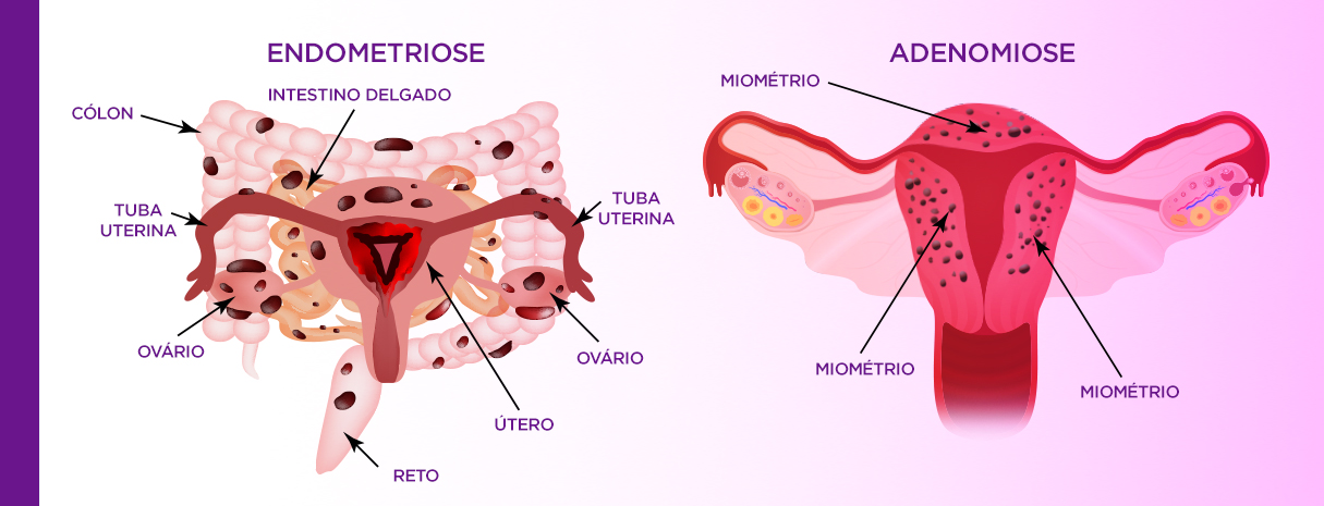 Endometriose Vs Adenomiose Qual A Diferença Br 3245