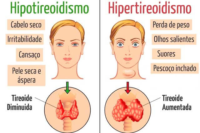 Tratamento para o Hipertireoidismo e Hipotireoidismo