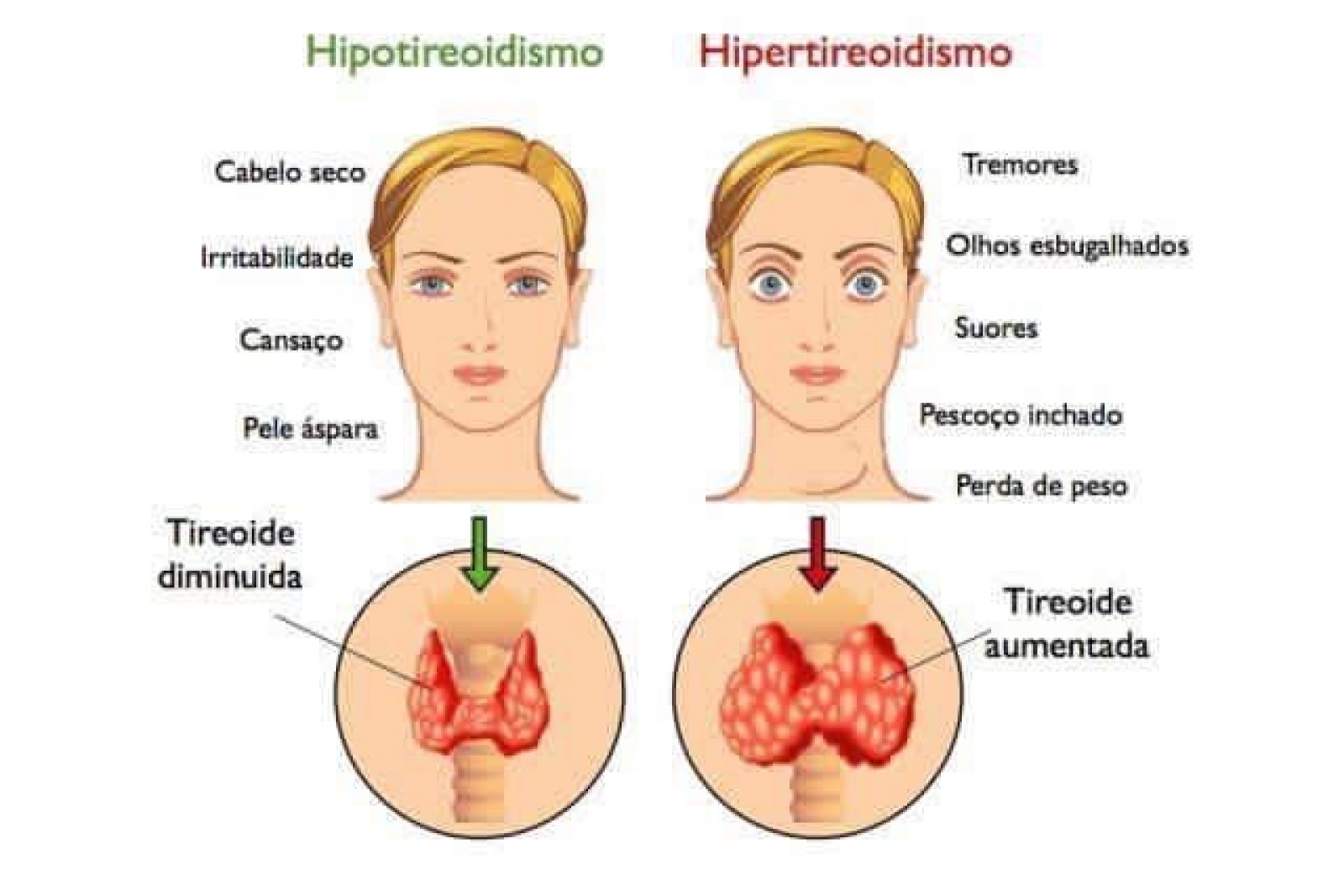 O Que é Hipotireoidismo e Hipertireoidismo?