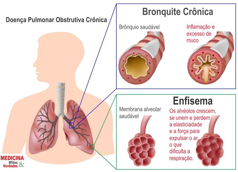 Sintomas e Complicações da Broncopatia Inflamatória