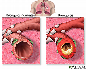 Tratamento e Prevenção da Broncopatia Inflamatória