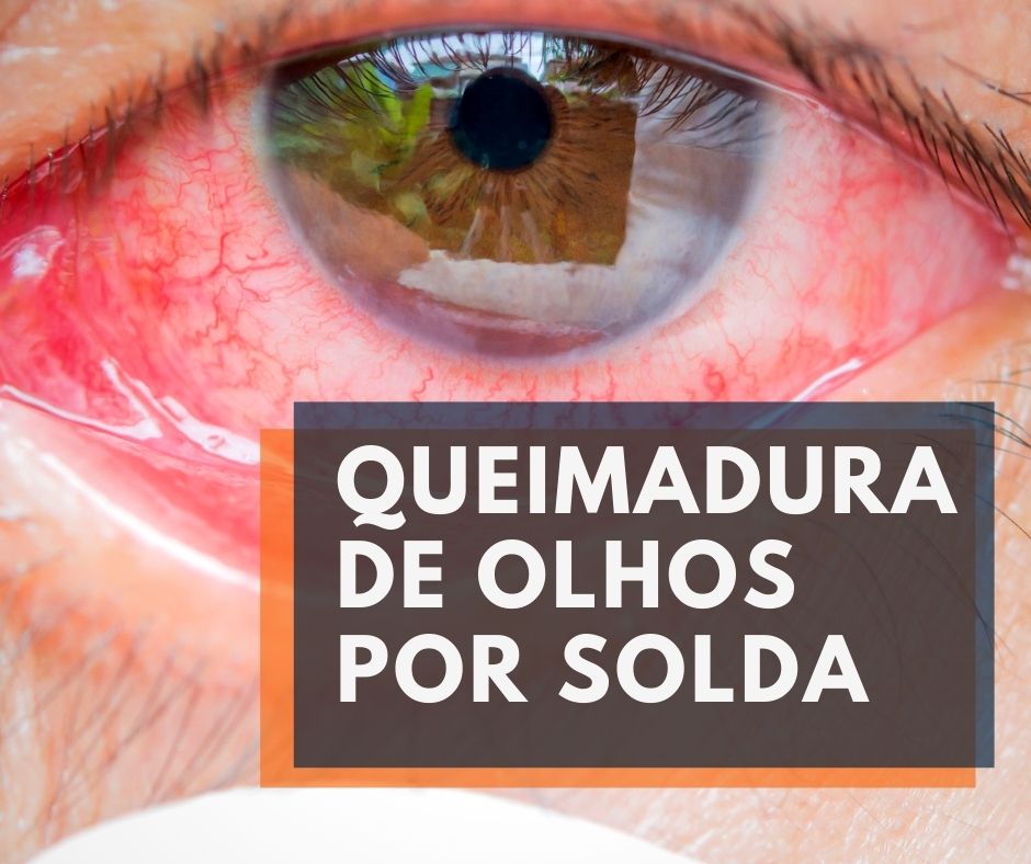 O Que Fazer Quando Seu Olho Queima com Solda?