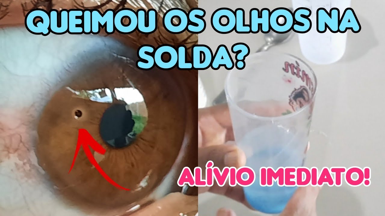 Como Aplicar o Tratamento Correto para Reduzir a Irritação e Inchaço dos Olhos Após uma Queimadura de Solda