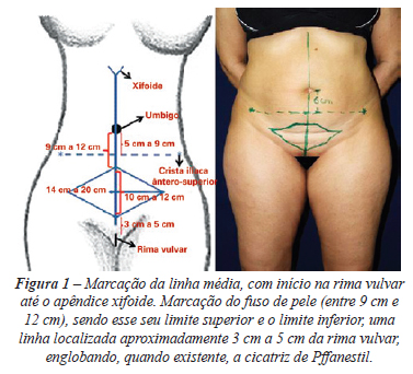 Compreendendo as Complicações da Região Suprapúbica