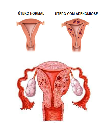 Os Benefícios do Miométrio Heterogêneo