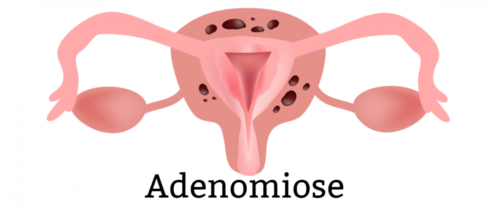 Como Diagnosticar um Miométrio Heterogêneo?