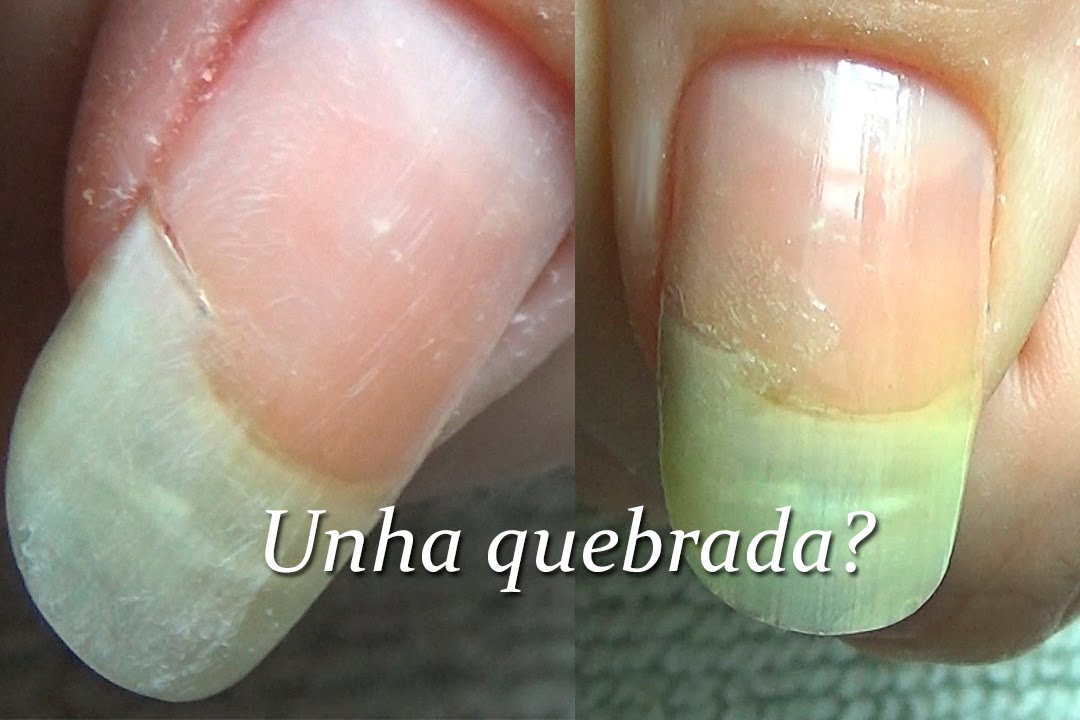 Como Prevenir a Quebra de Unhas na Carne