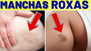 Quais são as possíveis causas de manchas roxas na mama?