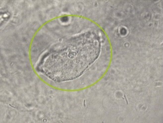 Como Identificar e Tratar as Células Epiteliais Raras