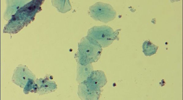 Os Riscos Associados à Presença Elevada de Lactobacillus sp