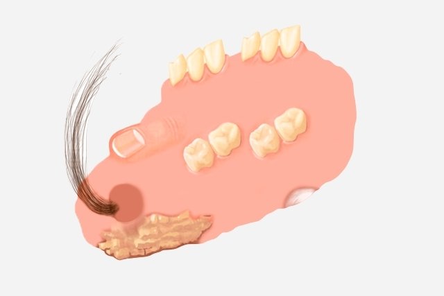 O Que Nós Sabemos Sobre o Cabelo e os Dentes de Mioma?