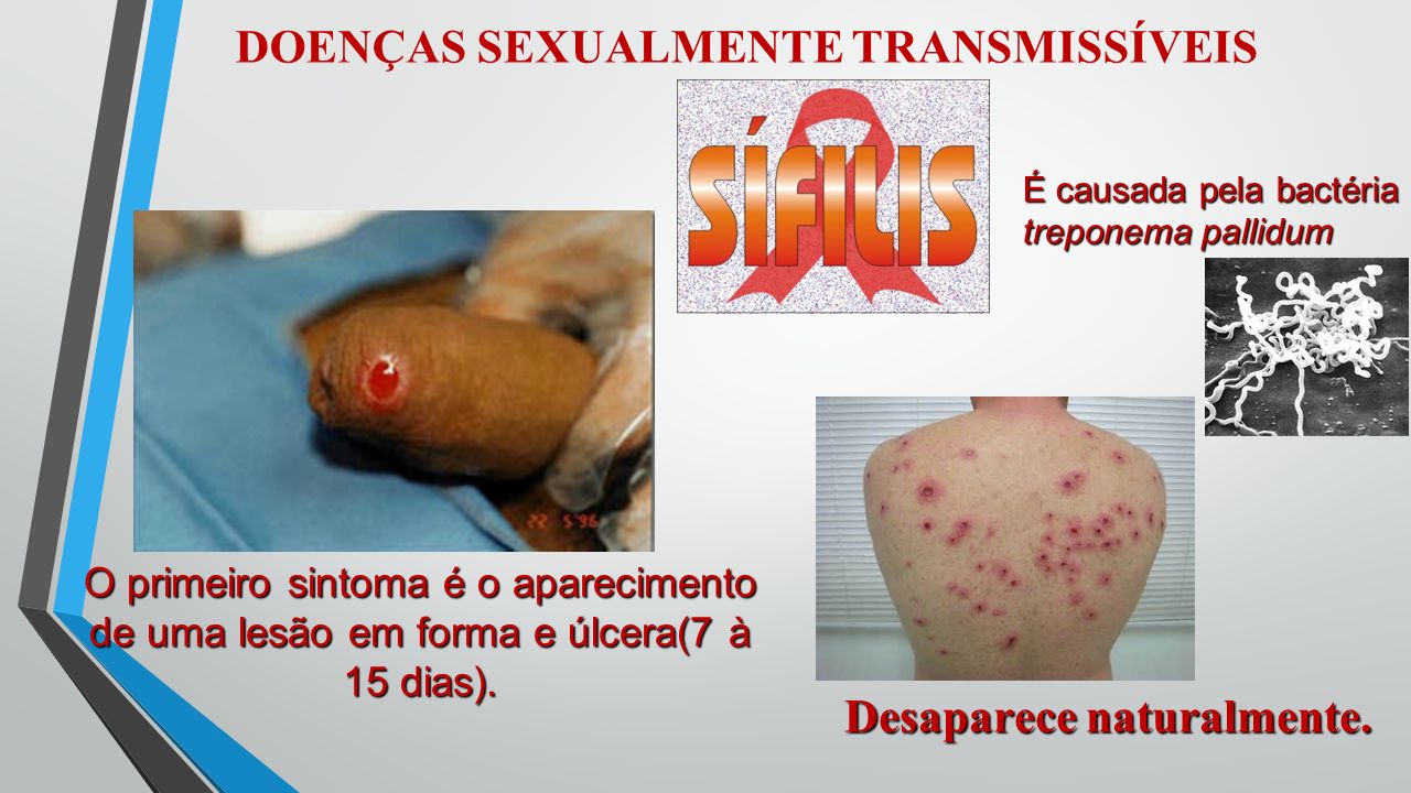 Os Riscos e Sintomas das DSTs