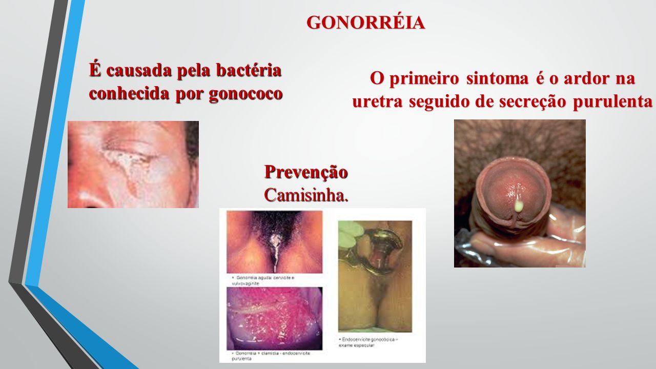 Prevenção contra DSTs