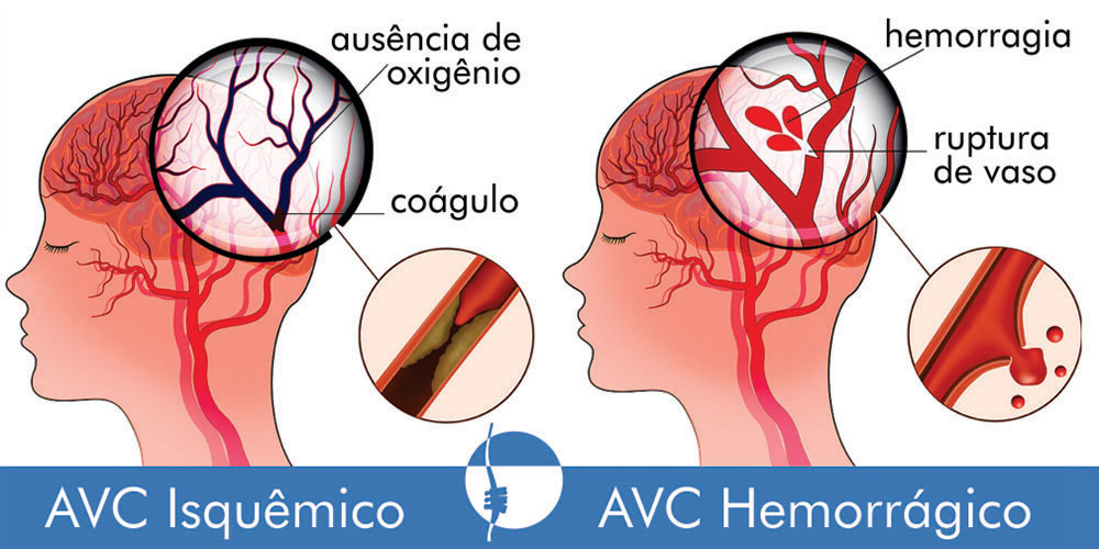 Como São Diagnosticados os Dois Tipos de Acidente Vascular Cerebral?