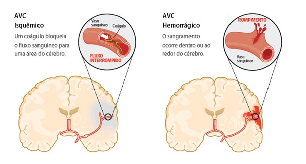 Quais são as Principais Diferenças Entre AVC e Derrame?