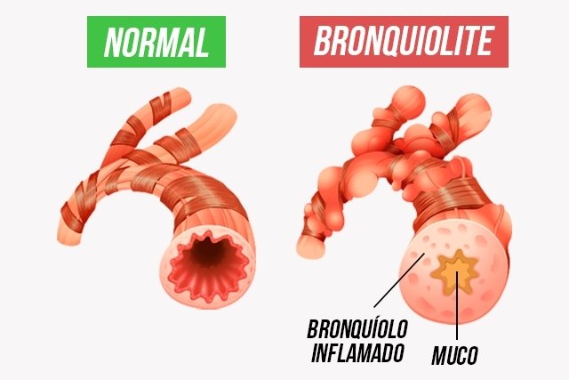 Qual Tratamento É Recomendado Para Cada Uma das Condições?