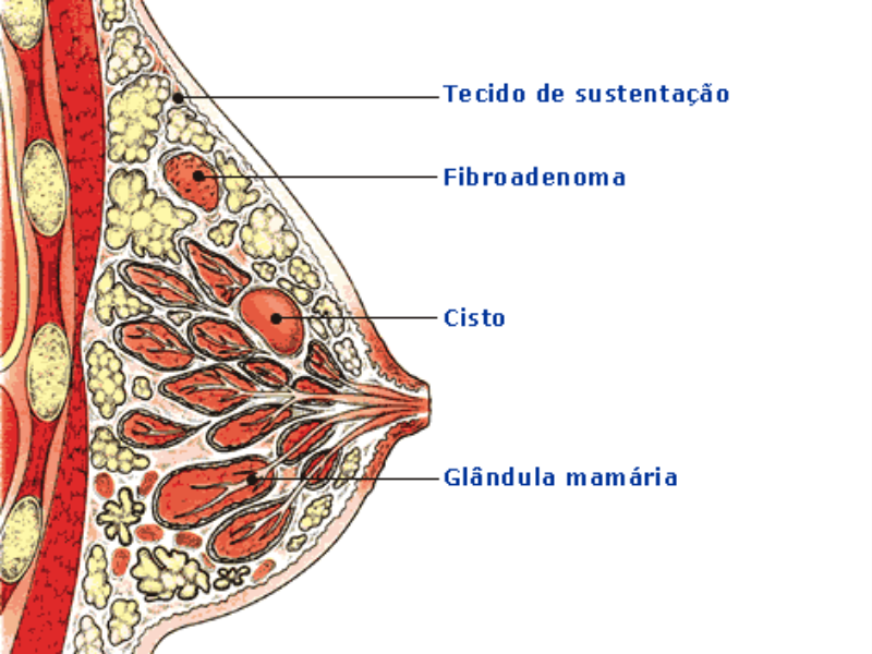 Quando Devemos Nos Preocupar com Cistos ou Nódulos?