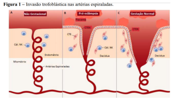 Complicações da Eclampsia e Pré-Eclampsia