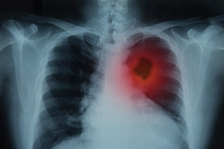 Quais são as Diferenças Entre Tumor e Câncer?