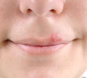 Quais Tratamentos Estão Disponíveis para a Herpes?