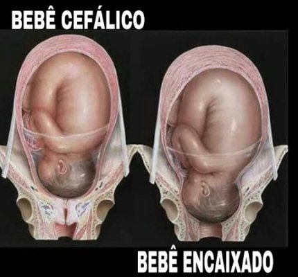 O Que Fazer Se Você Estiver Grávida e Com o Bebê Encaixado?