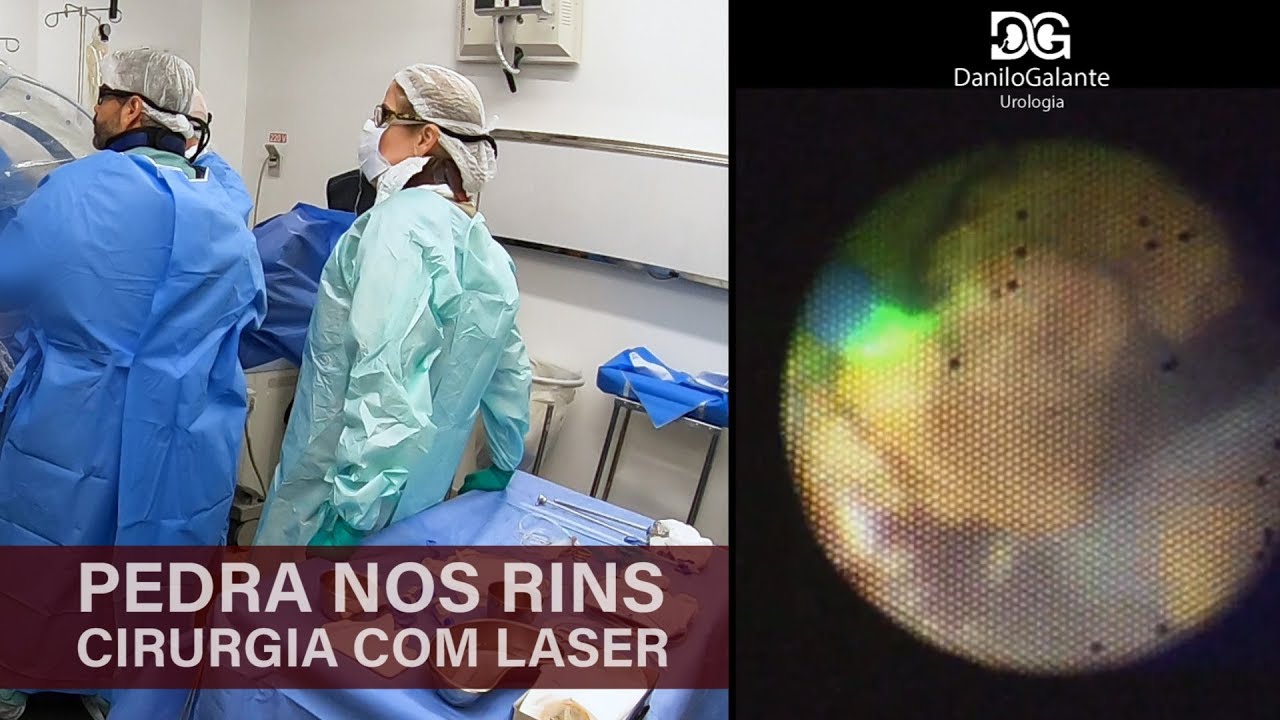 Descubra os Custos da Cirurgia a Laser de Pedra nos Rins