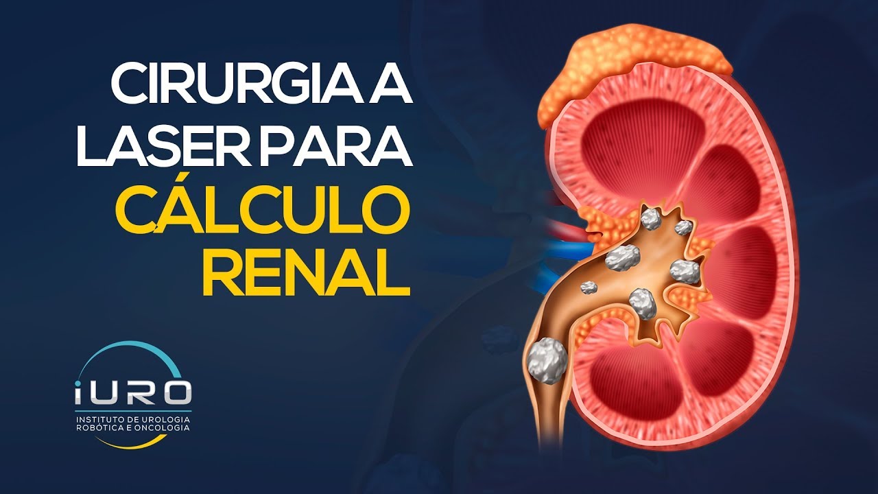 O Que é Necessário para uma Cirurgia a Laser de Pedra nos Rins?