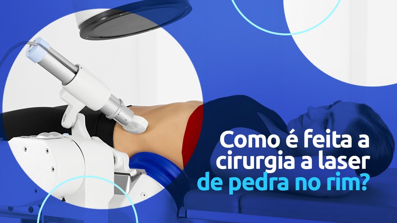 Os Benefícios e Desvantagens da Cirurgia a Laser de Pedra nos Rins