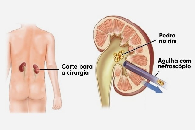 Quais são os Fatores que Influenciam o Preço da Cirurgia a Laser de Pedra nos Rins?