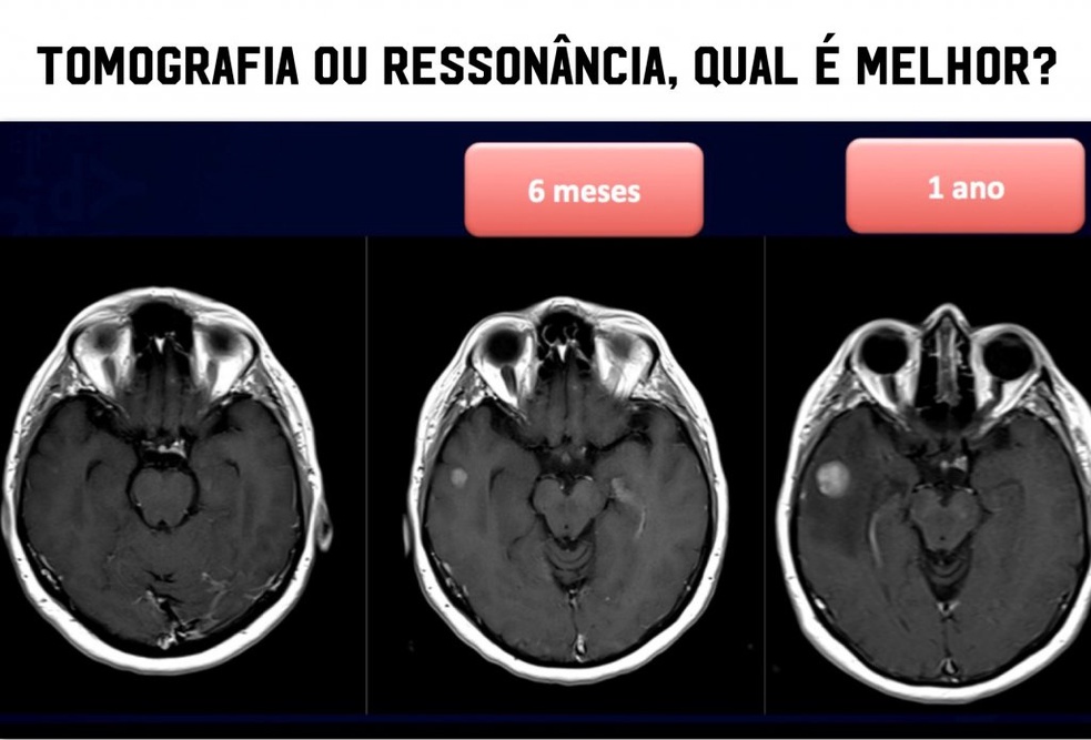 Quais São as Diferenças Entre Tomografia e Ressonância?